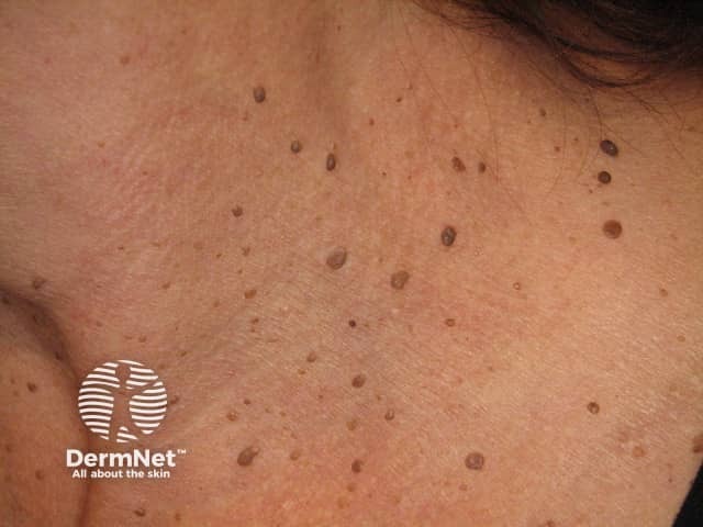 Dermatose papulosa nigra