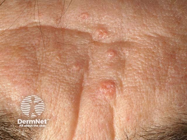 Hiperplasia sebácea